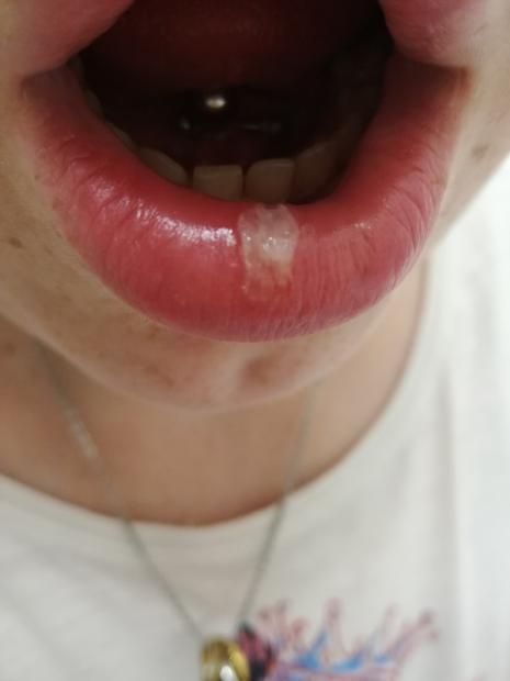 Ustionarsi Con La Ecig! [SigarettaElettronicaForum.com]